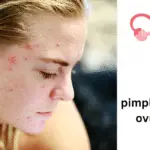 pimples during ovulation​